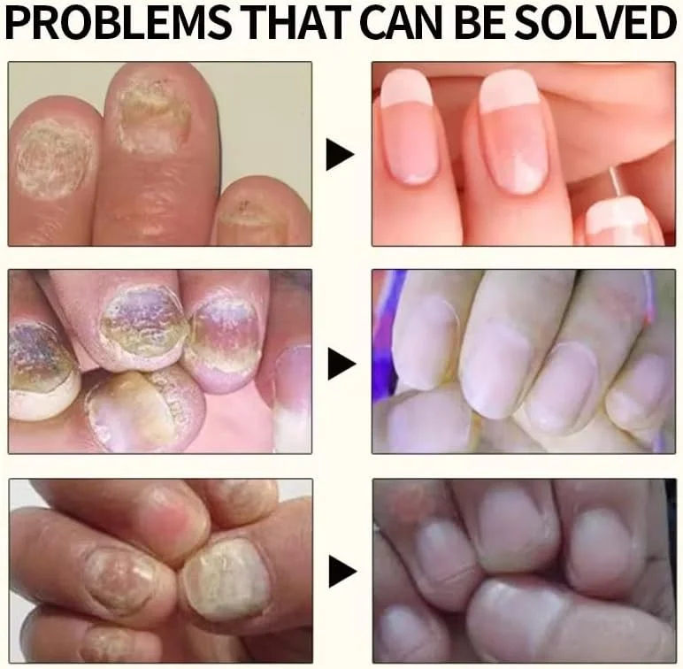 سرم ترمیم کننده ناخن، درمان ناخن های آسیب دیده، تقویت کننده و ترمیم کننده ناخن های شکننده