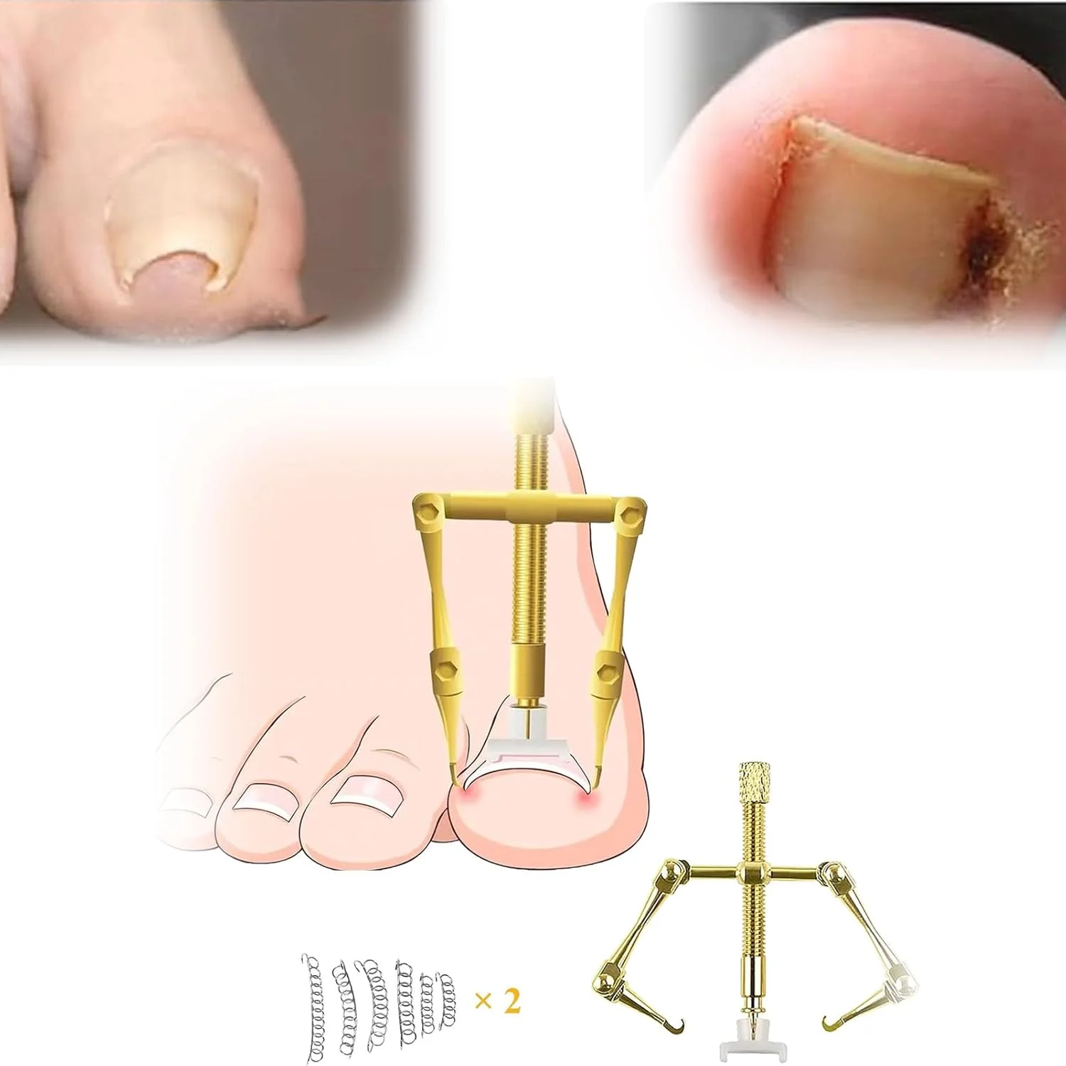 ست درمان ناخن فرورفته NALACAL، ابزار پدیکور استیل ضد زنگ برای اصلاح انحنای ناخن فرورفته، ست ابزار برای ناخن فرورفته، طلایی ست درمان ناخن فرورفته NALACAL، ابزار پدیکور استیل ضد زنگ برای اصلاح انحنای ناخن فرورفته، ست ابزار برای ناخن فرورفته، طلایی