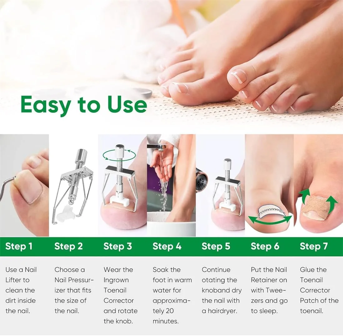 کیت درمان ناخن فرورفته در گوشت، تسکین موثر درد ناخن، شامل اصلاح کننده ناخن فرورفته، نوارهای اصلاحی، نگهدارنده های پدیکور ناخن، موچین و پدهای اصلاح ناخن