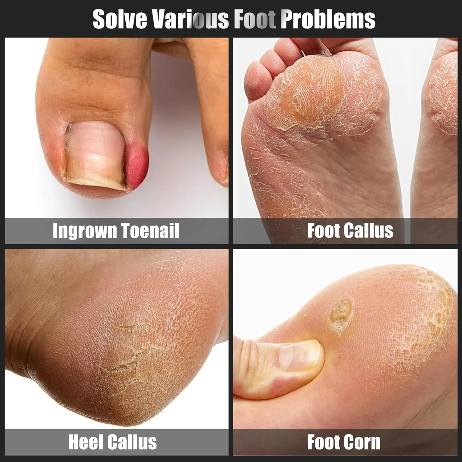 مجموعه ۷ تکه درمان ناخن پا فرورفته، کیت حرفه ای استیل ضد زنگ برای برداشتن ناخن پا فرورفته، ابزار از بین بردن پینه پا، ابزار مانیکور و پدیکور برای پا (تمیز کردن زیر ناخن + مراقبت از پا)