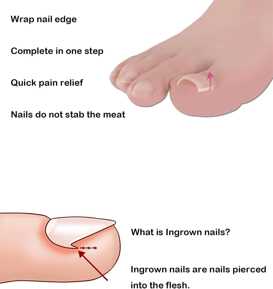 کیت درمان حرفه ای ناخن فرورفته، 50 عدد نوار صاف کننده و اصلاح کننده ناخن فرورفته همراه با 2 عدد سوهان و لیفتر ناخن فرورفته برای بهبود ناخن های خمیده