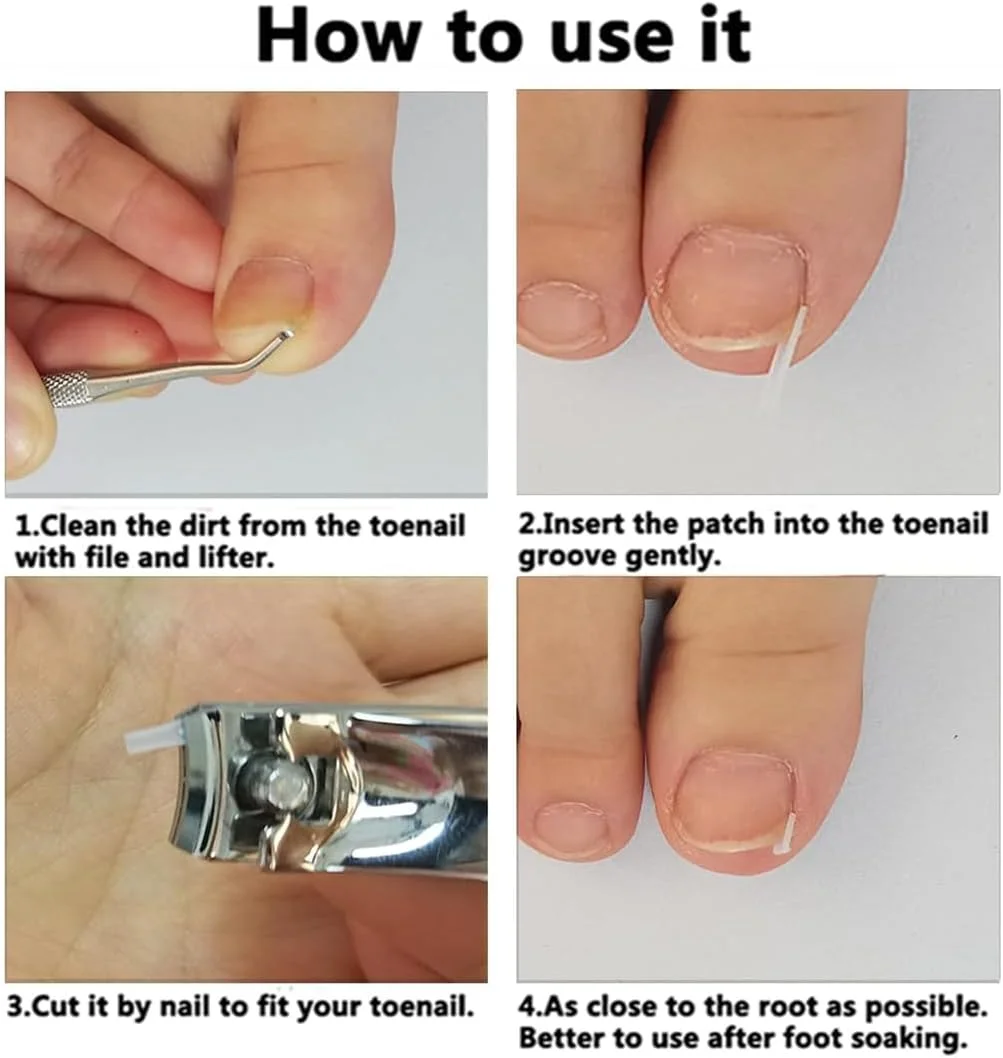 کیت درمان حرفه ای ناخن فرورفته، 50 عدد نوار صاف کننده و اصلاح کننده ناخن فرورفته همراه با 2 عدد سوهان و لیفتر ناخن فرورفته برای بهبود ناخن های خمیده