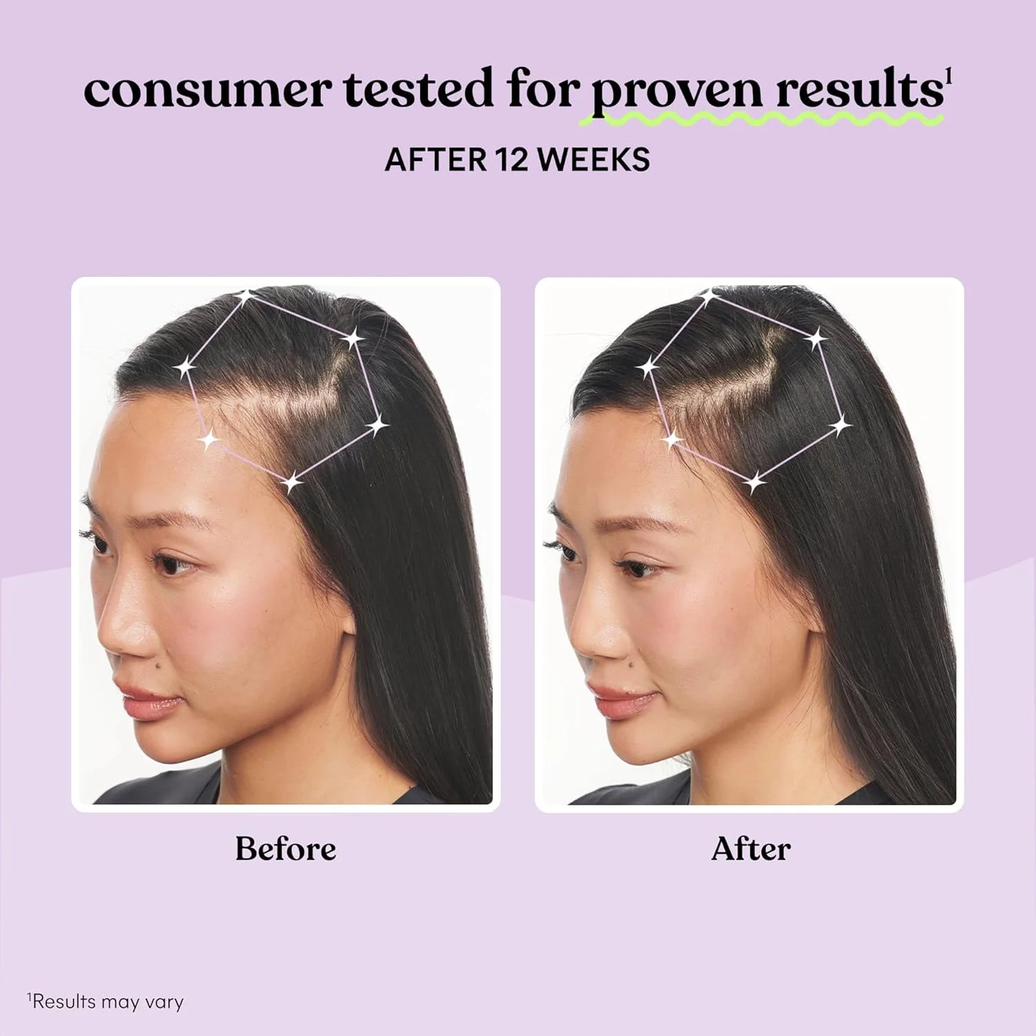 مکمل رشد موی لم برای بانوان، کمپلکس کراتین با اثربخشی بالینی برای موهای ضخیم تر و پوشش بیشتر پوست سر، کاهش ریزش مو، تغذیه موهای نازک - بسته یک ماهه مکمل رشد موی لم برای بانوان، کمپلکس کراتین با اثربخشی بالینی برای موهای ضخیم تر و پوشش بیشتر پوست سر، کاهش ریزش مو، تغذیه موهای نازک - بسته یک ماهه