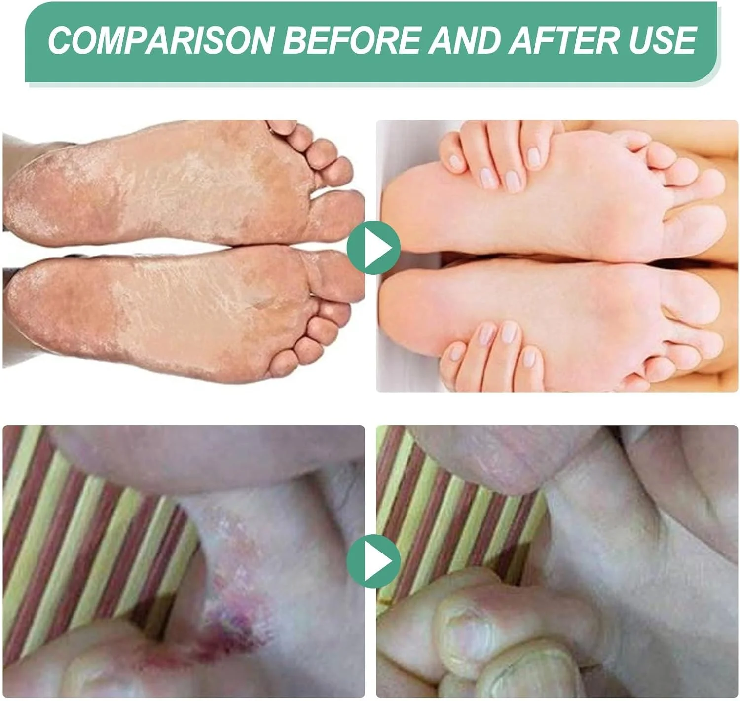 اسپری پای ورزشکاران 100 میلی لیتری، اسپری کفش پای ورزشکاران برای پاهای عرق کرده، اسپری تسکین دهنده قارچ پا، از بین برنده بوی پا، اسپری خوشبو کننده و ضدعفونی کننده پا مناسب برای همه، اسپری لایه بردار فوری پا اسپری پای ورزشکاران 100 میلی لیتری، اسپری کفش پای ورزشکاران برای پاهای عرق کرده، اسپری تسکین دهنده قارچ پا، از بین برنده بوی پا، اسپری خوشبو کننده و ضدعفونی کننده پا مناسب برای همه، اسپری لایه بردار فوری پا