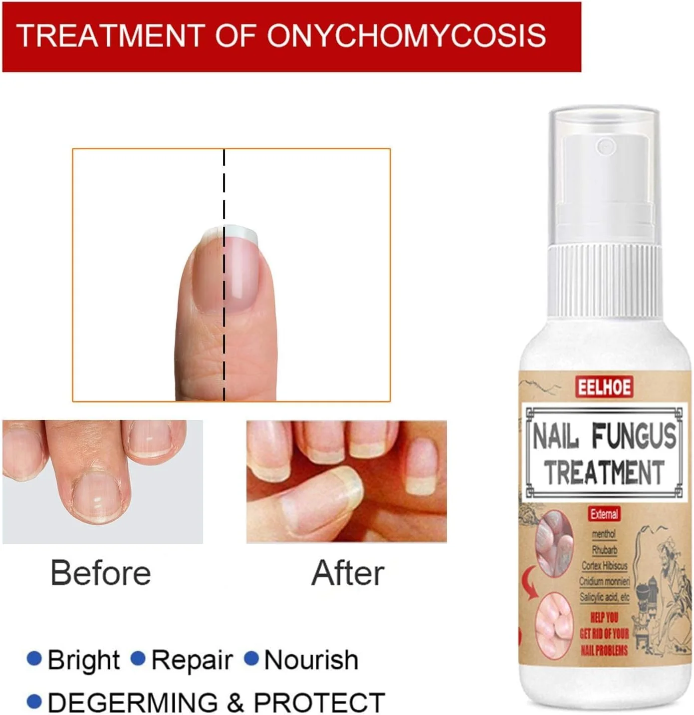 اسپری ترمیم ناخن ZYZY، درمان تغییر رنگ و آسیب دیدگی ناخن، اسپری ترمیم ناخن ضد قارچ برای ناخن های دست و پا