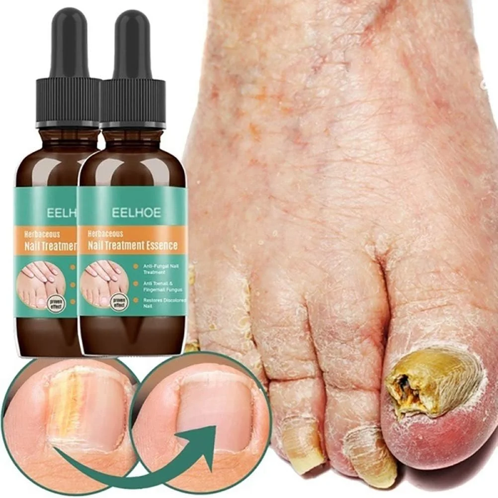 مایع ضد قارچ، 30 میلی لیتر، محلول ضد قارچ برای انگشتان دست و پا