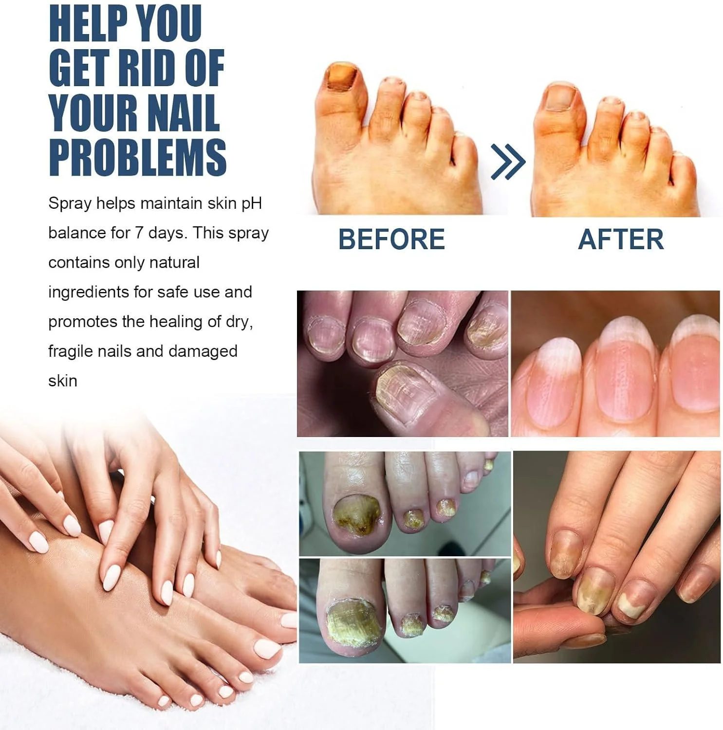 اسپری پای ورزشکاران Rhomba، حاوی مواد طبیعی، درمان پای ورزشکاران، تسکین سریع و موثر التهاب و خارش قارچ پا