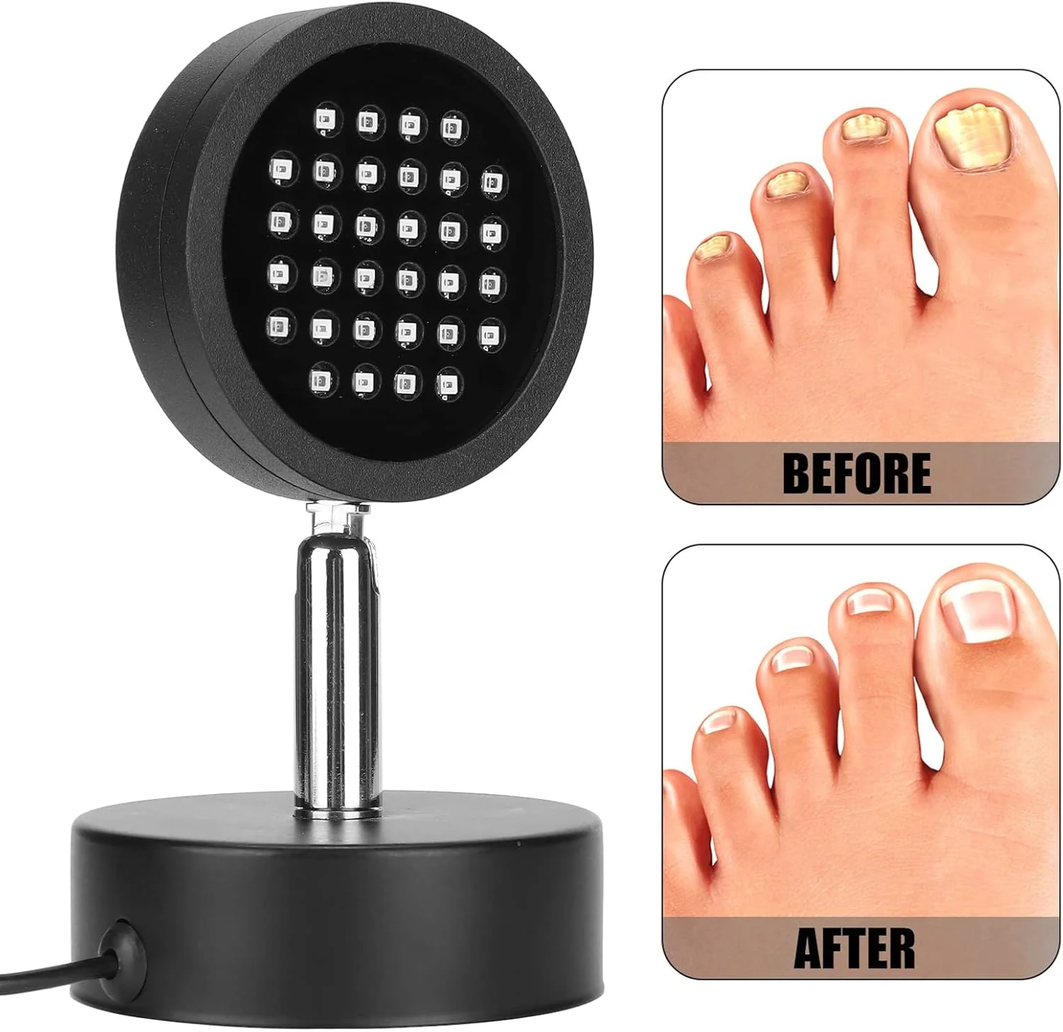 دستگاه درمان ناخن پا، قابل حمل، بدون درد و ایمن برای رفع قارچ