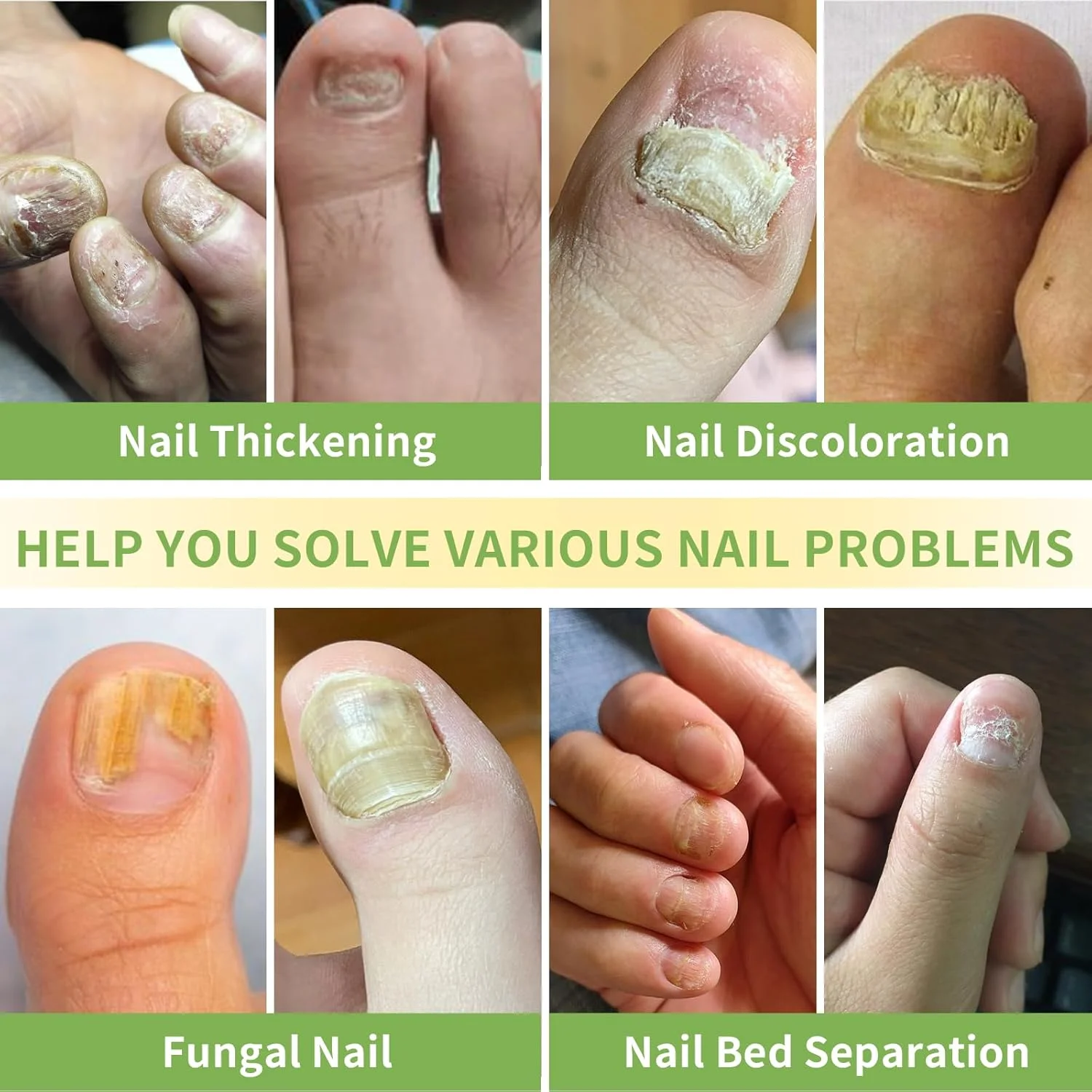 دستگاه لیزر درمان قارچ ناخن، دستگاه لیزر ضد قارچ برای ناخن پا و ناخن دست و اونیکومیکوز، نور آبی 470 نانومتر، نور قرمز 660 نانومتر و نور مادون قرمز 905 نانومتر (سبز)