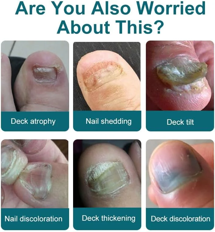 محلول قوی ترمیم ناخن (30 میلی لیتر) - محلول ناخن برای ناخن های پا، پشتیبانی از ظاهر سالم و رشد ناخن