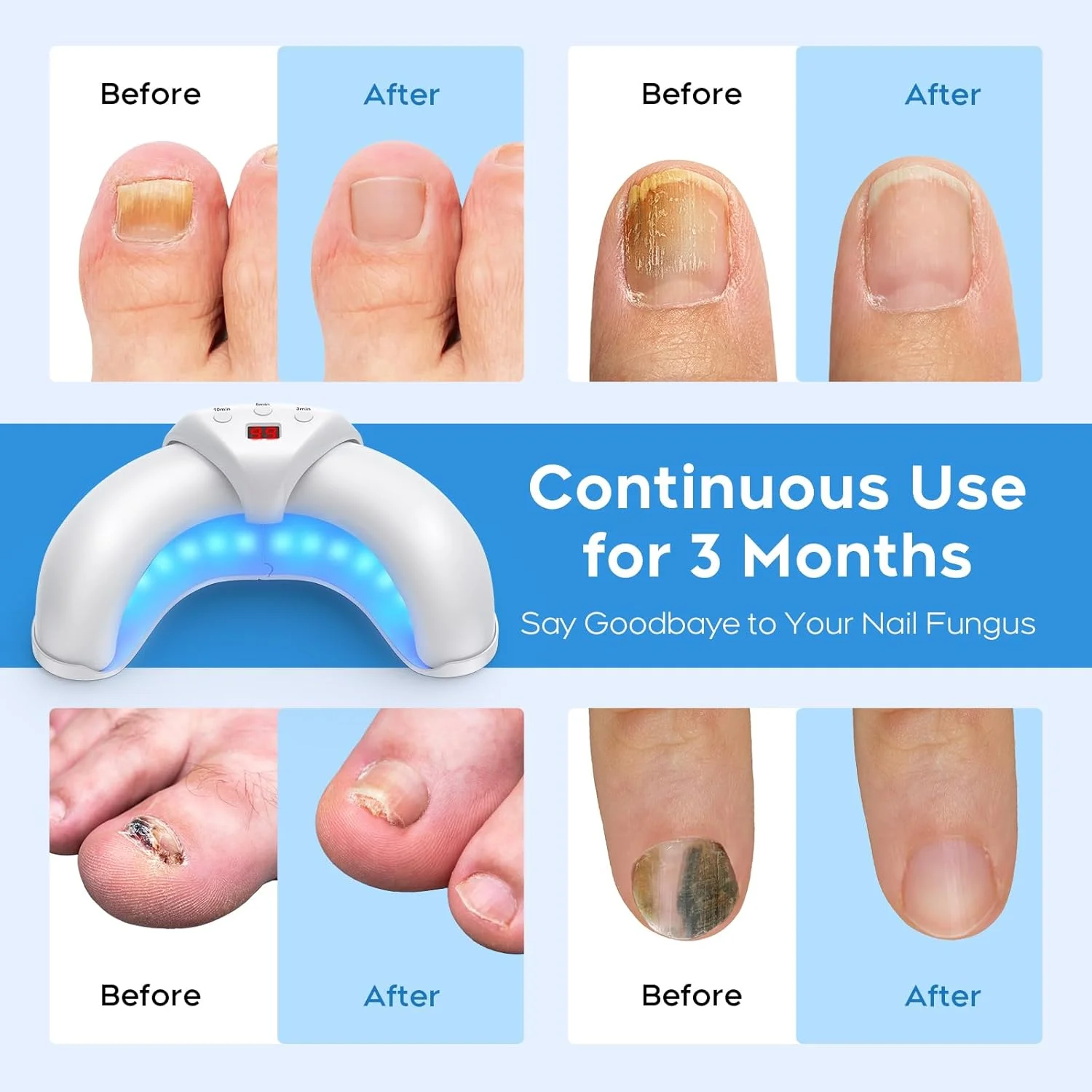 دستگاه لیزر قارچ ناخن برای چندین ناخن پا و دست، راه حل ترمیم ناخن برای ناخن های آسیب دیده و تغییر رنگ داده، مناسب برای استفاده در منزل
