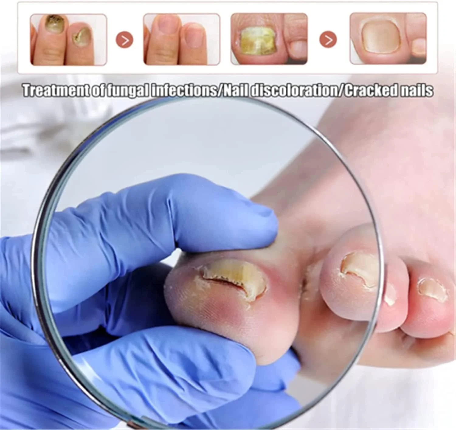 روغن درمان قارچ ناخن پا، روغن مراقبت از ناخن، روغن قارچ پا، برای ترمیم ناخن های آسیب دیده و تغییر رنگ یافته (1 عدد)