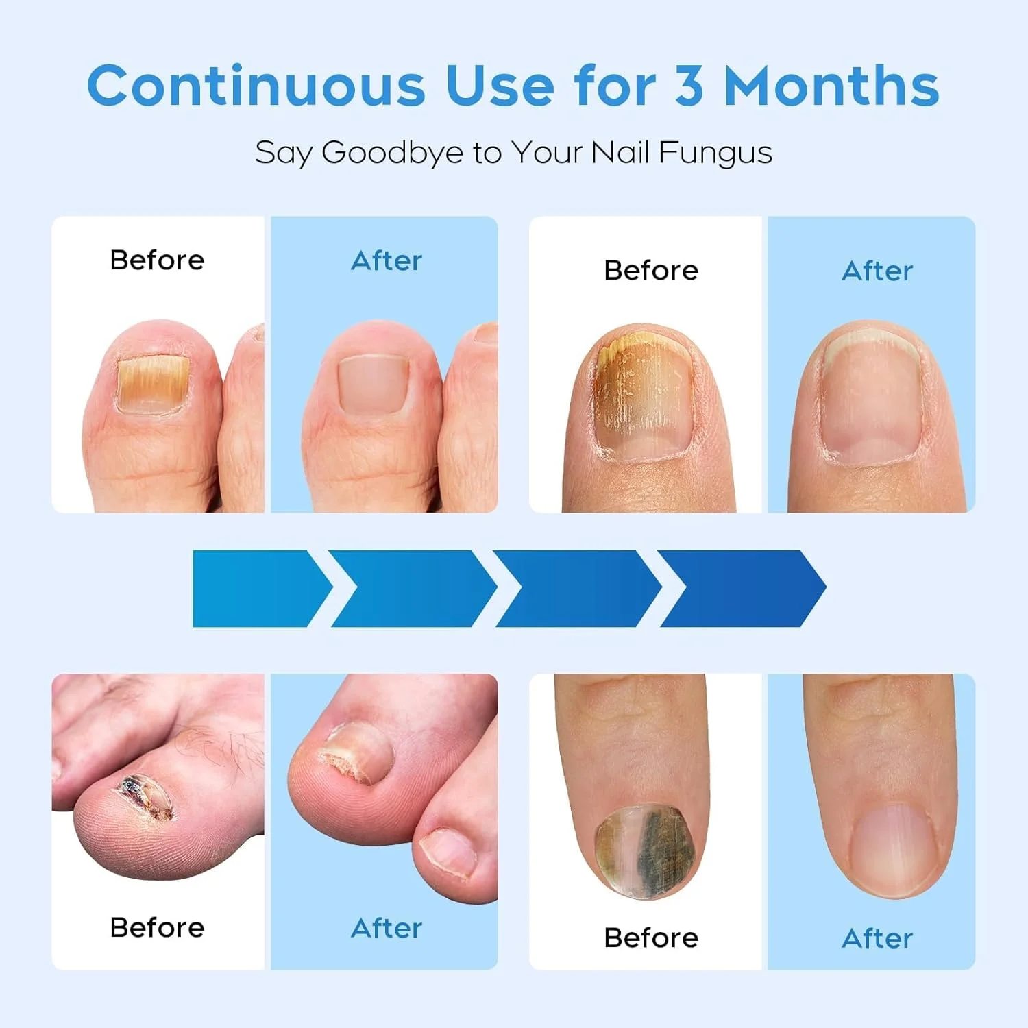 دستگاه لیزر ناخن برای چندین ناخن پا و دست، راه حل ترمیم ناخن برای ناخن های آسیب دیده و تغییر رنگ داده، مناسب برای استفاده در منزل