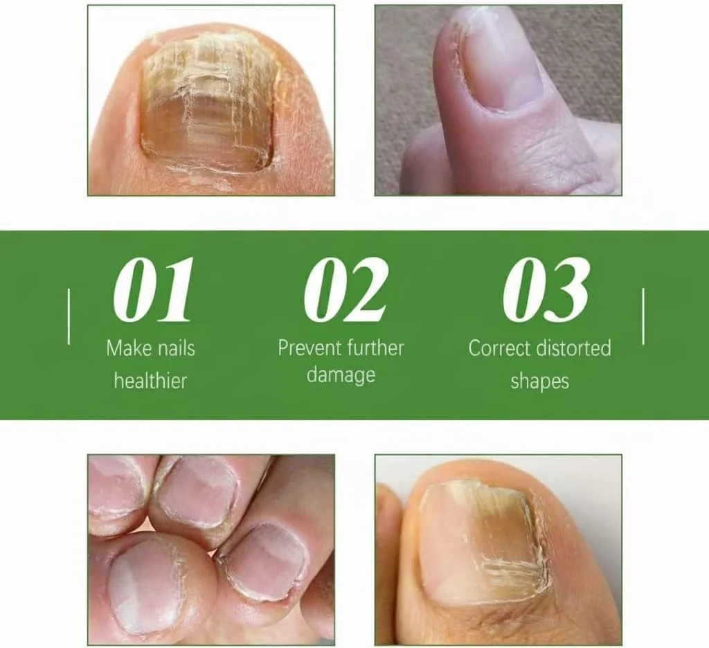 قلم مراقبت از ناخن برای روتین سلامتی - درمان قارچ ناخن با روغن درخت چای، ویتامین E و آلوئه ورا - مراقبت موثر برای عفونت قارچی (بسته 2 عددی) (متوسط)