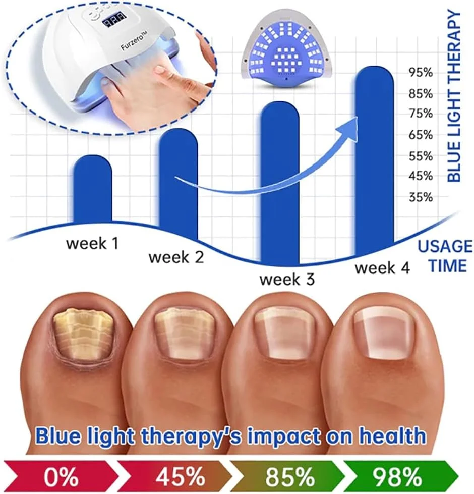 دستگاه لیزر تراپی قارچ ناخن Purenail Furzero، دستگاه نور درمانی ناخن قارچی، دستگاه نور درمانی با راندمان بالا برای بیماری های ناخن پا