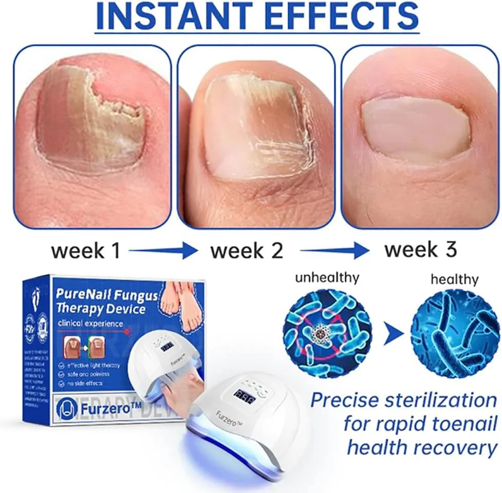 دستگاه لیزر تراپی قارچ ناخن Purenail Furzero، دستگاه نور درمانی ناخن قارچی، دستگاه نور درمانی با راندمان بالا برای بیماری های ناخن پا