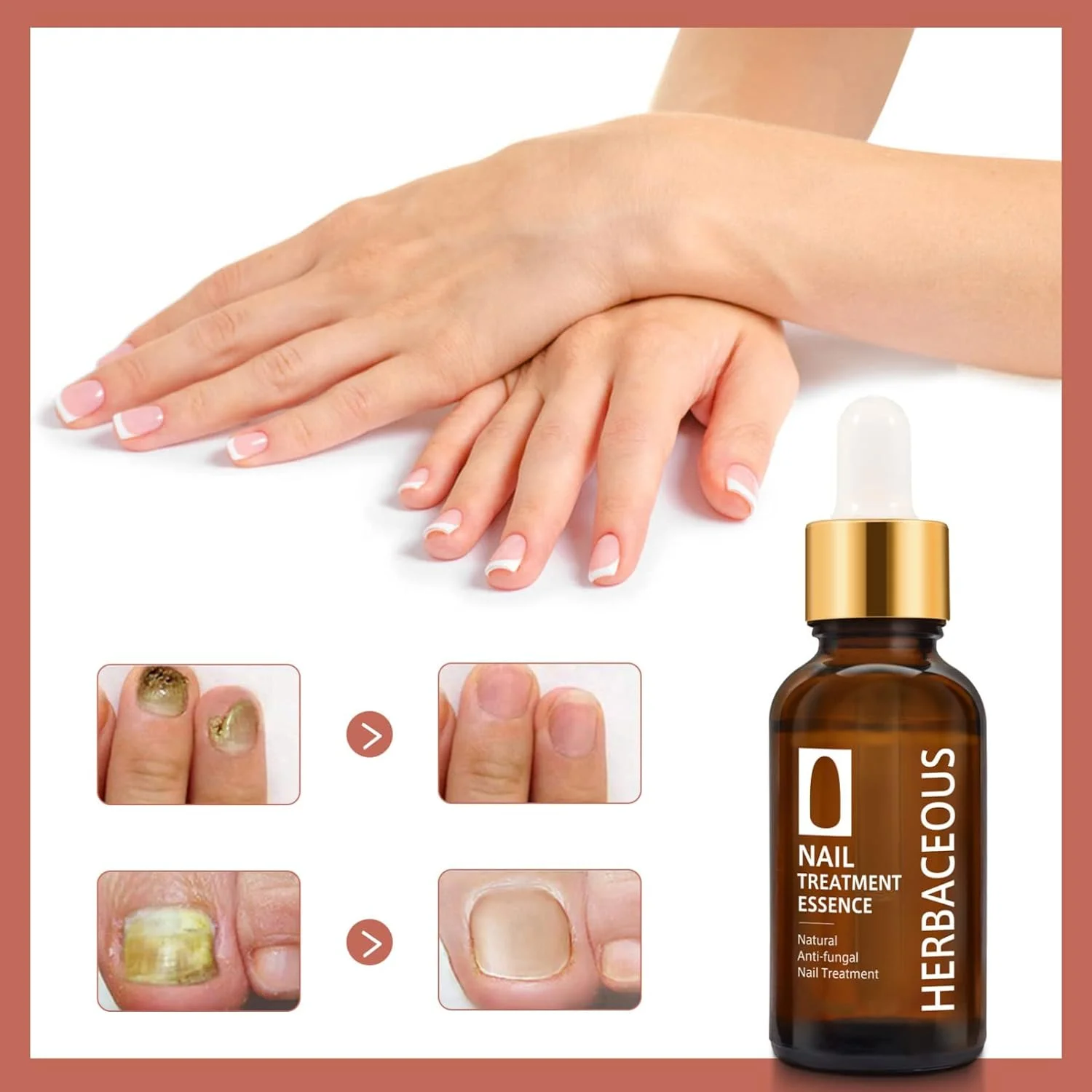 محلول درمان قارچ ناخن، از بین برنده برتر قارچ ناخن برای ناخن های پا و دست، درمان قارچ ناخن، ترمیم ناخن انگشت ضد قارچ
