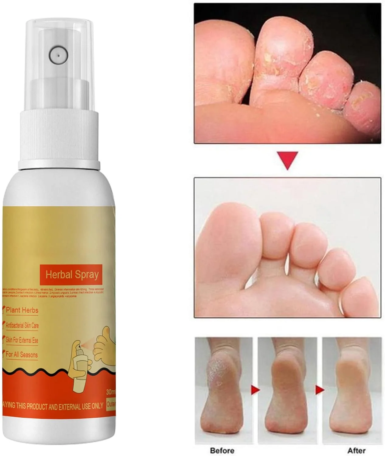 اسپری درمان پای ورزشکاران، اسپری ضد قارچ پا، اسپری مایع درمان پای ورزشکاران، خوشبو کننده پا، برای درمان درماتوفیتوزیس و رفع بوی بد اسپری درمان پای ورزشکاران، اسپری ضد قارچ پا، اسپری مایع درمان پای ورزشکاران، خوشبو کننده پا، برای درمان درماتوفیتوزیس و رفع بوی بد