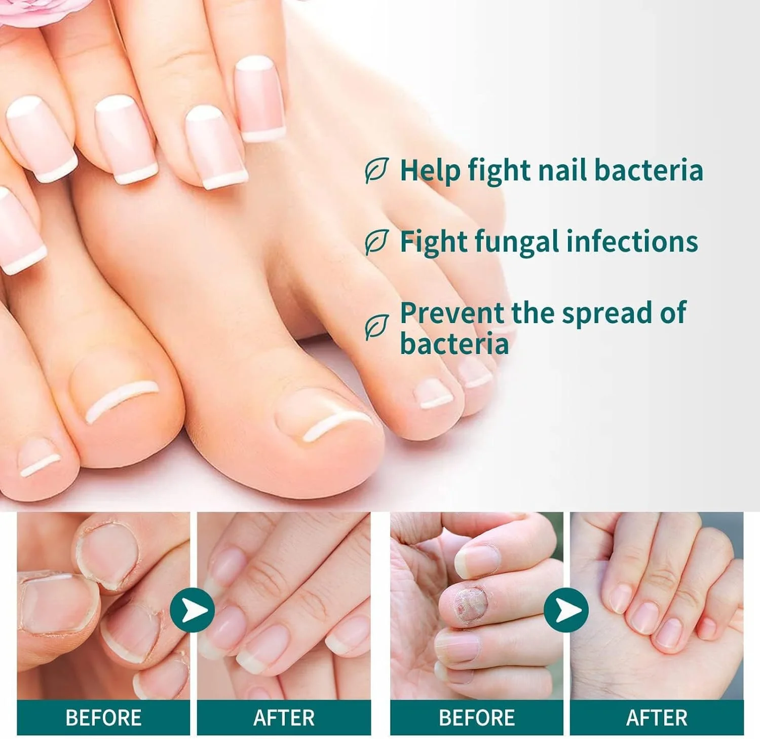محلول درمان ناخن قارچی آزونی، اسانس ترمیم کننده قوی ناخن برای ناخن های پا، سرم ضد قارچ طبیعی برای ناخن های دست و پا، لاک ناخن ضد قارچ برای ناخن های دست و پا