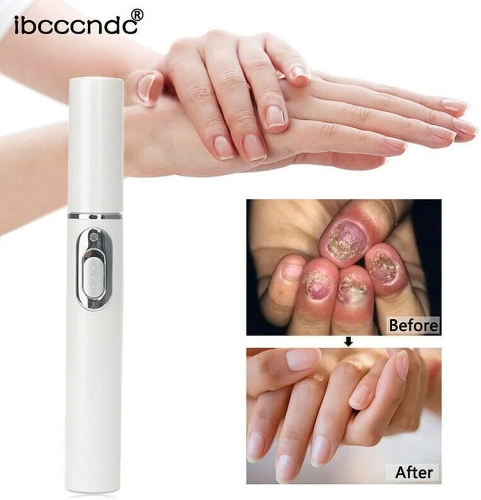 کیت درمان خانگی ضد قارچ - قلم لیزر نور آبی برای ترمیم قارچ (1 عدد قلم مراقبت از ناخن)